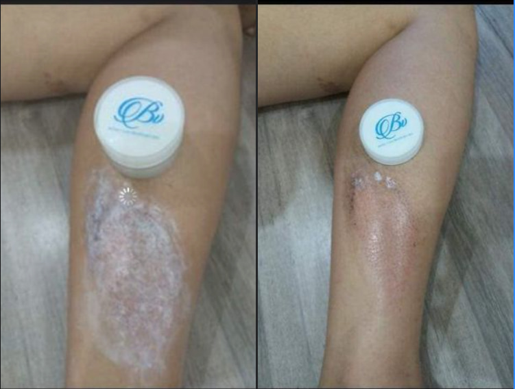 Bỏng bô xe máy