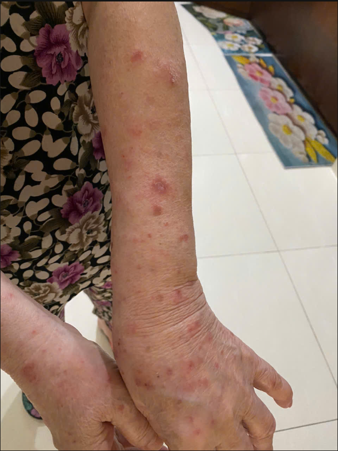 viêm da cơ địa người lớn tuổi mãn tính