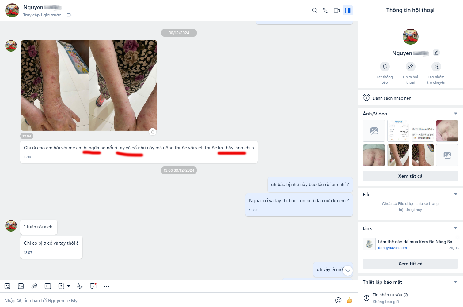 Viêm da cơ địa ở người lớn