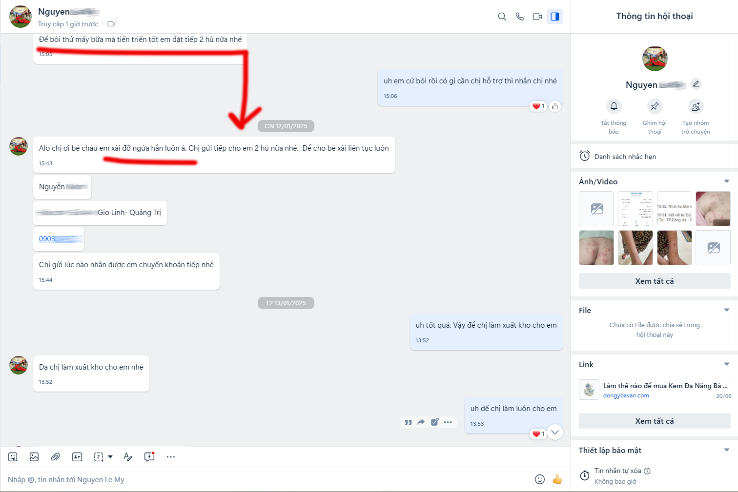 Viêm da cơ địa trẻ em bị ngứa gãi xước da